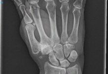 老化軟骨が「若返る」──15-PGDH阻害で関節軟骨を再生する新治療を発見